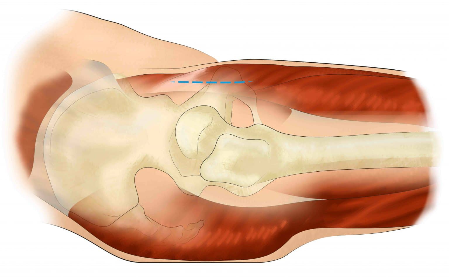 Prothèse totale de hanche mini invasive par voie antérieure Chirurgie du Sport Paris